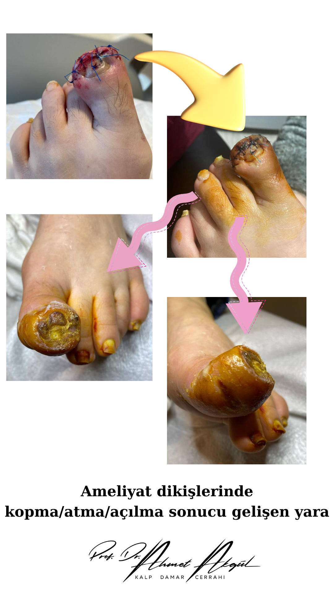 Ameliyat dikişlerinde kopma ve açılma sonucu gelişen yara