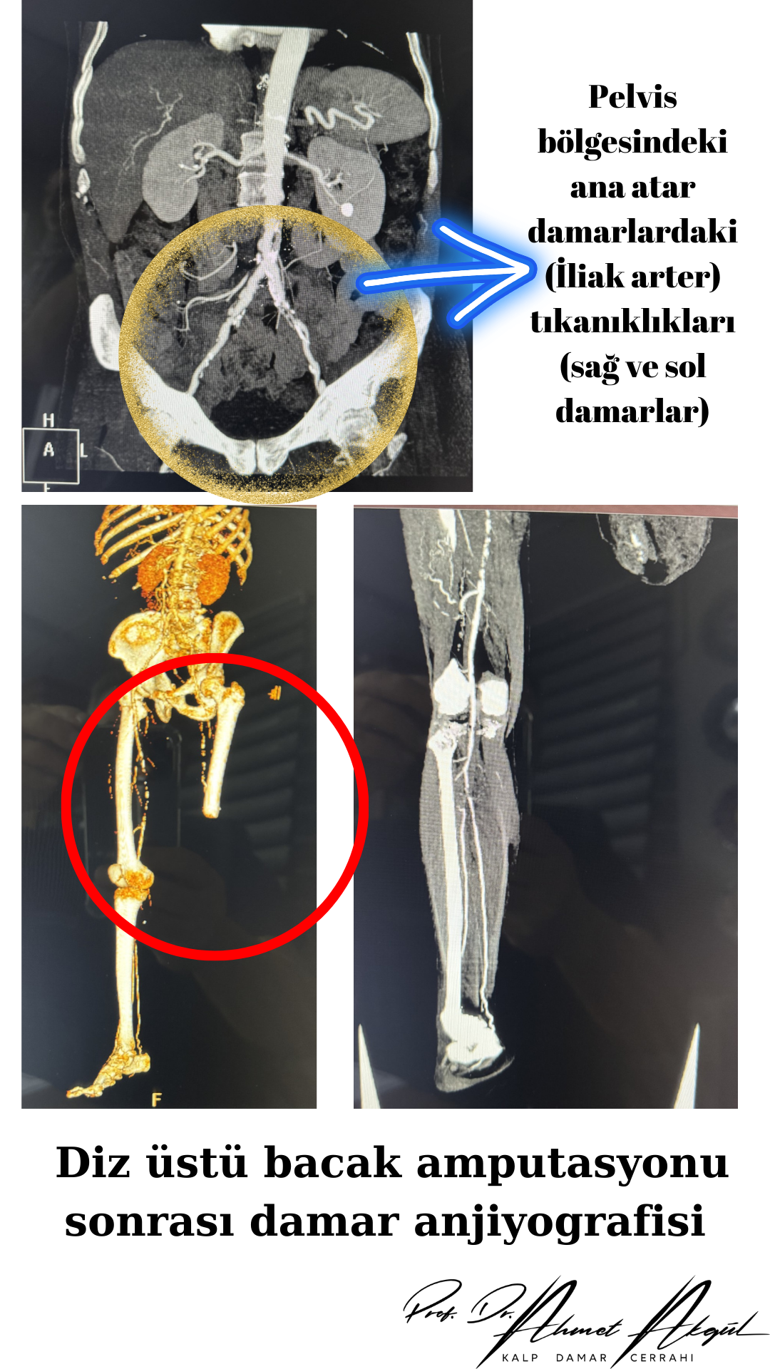 Diz üstü bacak amputasyonu sonrası damar anjiyografisi 1
