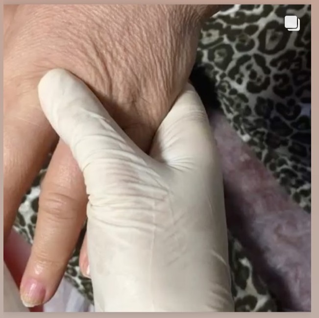prof dr ahmet akgul meme kanseri ameliyati sonrasi olusan kol sisligi lenfodemi